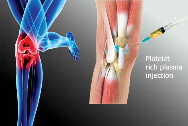 PRP Joint Injections: A Natural Path to Healing